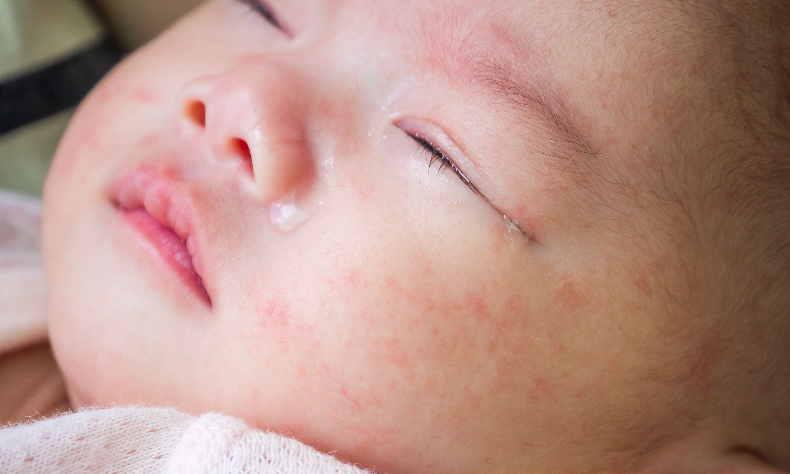 關(guān)于寶寶食物過敏，家長(zhǎng)要知道的4件事